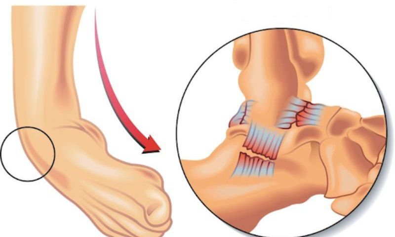 Những triệu chứng thường gặp của lật sơ mi